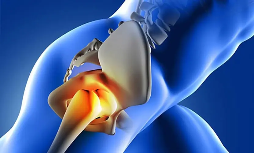 تعویض کامل مفصل ران