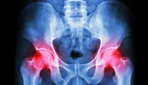 hip-replacement-alternative