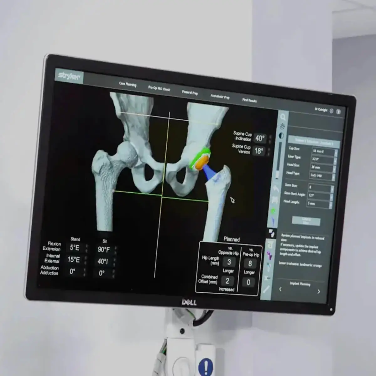 تعیین اندازه پروتز و برابری طول اندامها در جراحی کمتهاجمی دوطرفه لگن با فناوری کامپیوتری تعیین اندازه پروتز و برابری طول اندامها در جراحی کمتهاجمی دوطرفه لگن با فناوری کامپیوتری