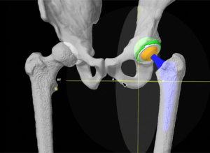 computer-assisted-bilateral-hip-replacement